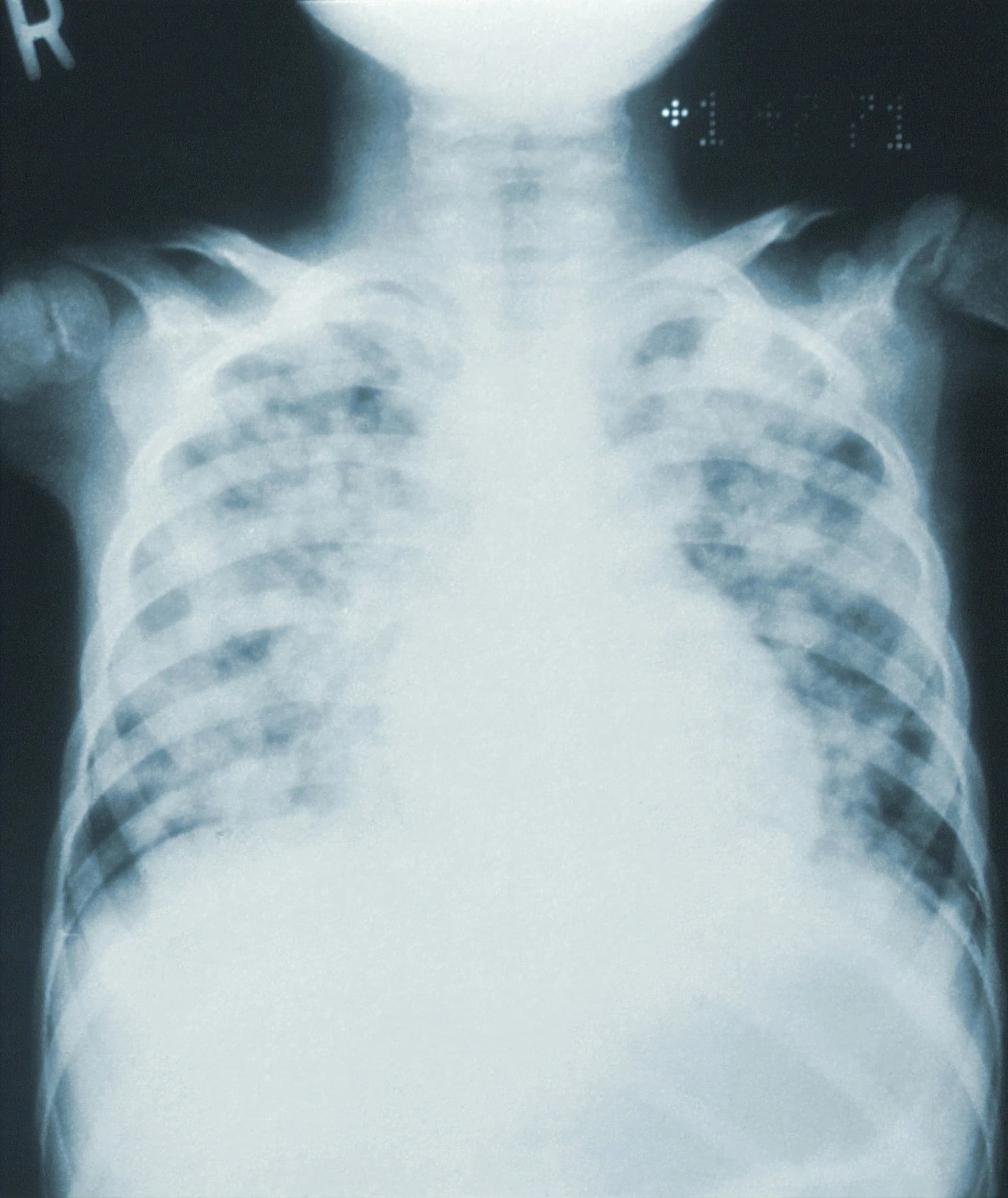 Pneumonie typique vs. atypique : comprendre les différences